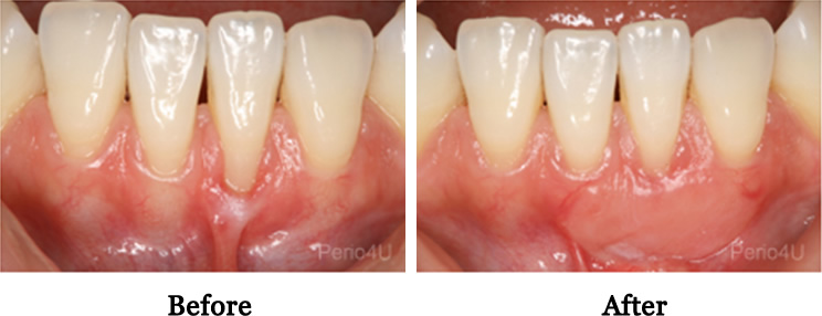 Gingival-Grafts-2