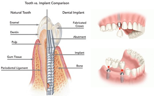 Dental Implants