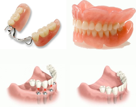 All Teeth Replacement | Tauranga Dental Specialists